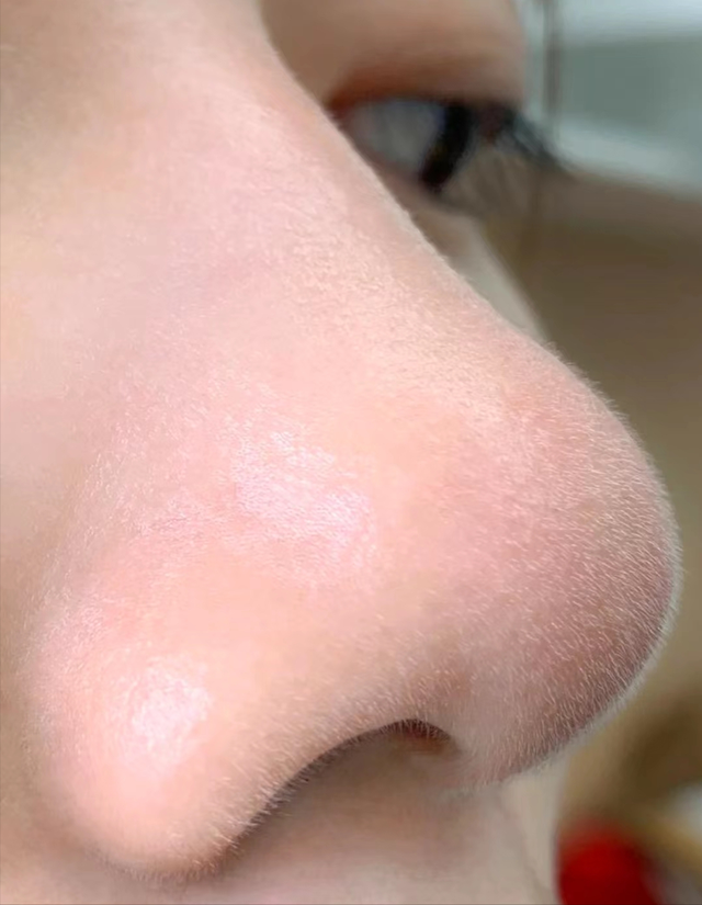 学生如何自己去黑头，想要短期内改善黑头情况