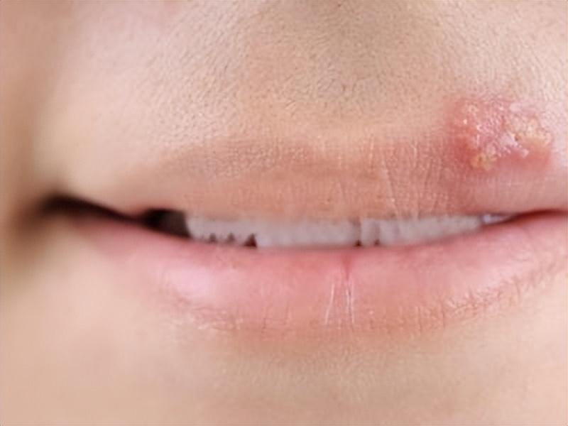 嘴巴周围起小水泡的原因