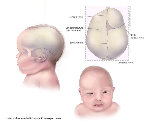 婴儿偏头最好的纠正法图解，宝宝头歪向左边应该怎样调整（还有办法“圆”回来吗）