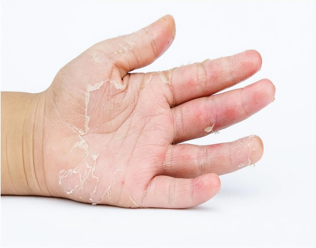 手掌蜕皮严重怎么办,手脱皮,长手癣是怎么引起的 - 玉三网