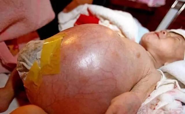 生孩子是从哪个部位生出来的，宫外孕的概率有多大（注定被“割”下的寄生胎）