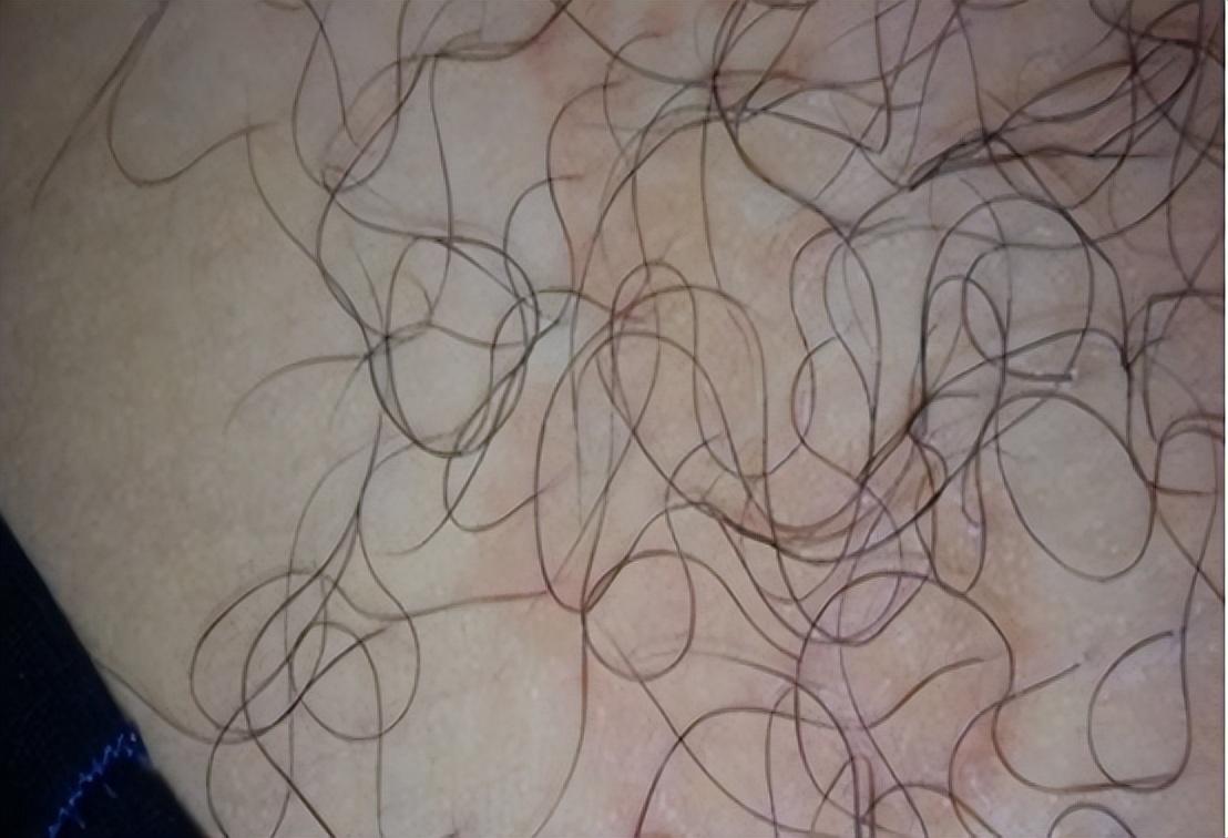 阴虱是什么原因得的怎么治,为什么现在很多人得阴虱 - 玉三网