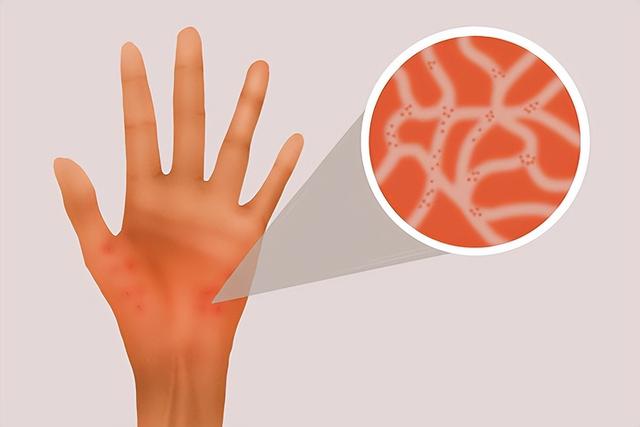 急性荨麻疹会自愈吗，急性荨麻疹止痒小妙招（医生：急性发作可能要命）