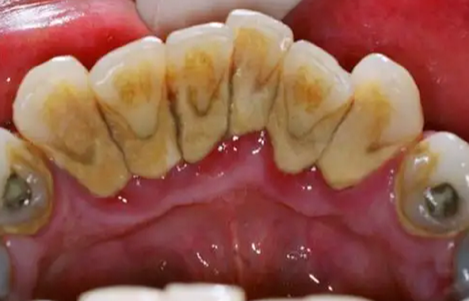 用醋能把牙齿上的结石刷掉吗(牙结石怎么去除小窍门食醋刷牙法)