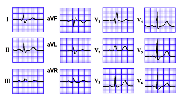 什么是大炮音，大炮音是怎样产生的（心律失常<五>）