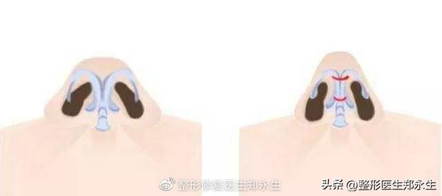 鼻头缩小术千万别做，鼻缩小手术千万别做（肉鼻子做了鼻头缩小结果越“缩”越“大”）