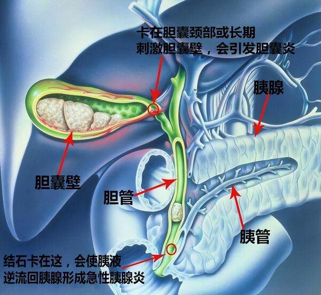 胆结石死亡率大吗，肝内胆管结石死亡率高吗（关于胆结石的那些事儿）