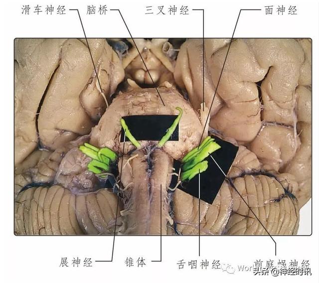 属于膜迷路的结构是，属于膜迷路的结构是蜗管蜗顶（彩图经典版│脑神经和脑神经核解剖）