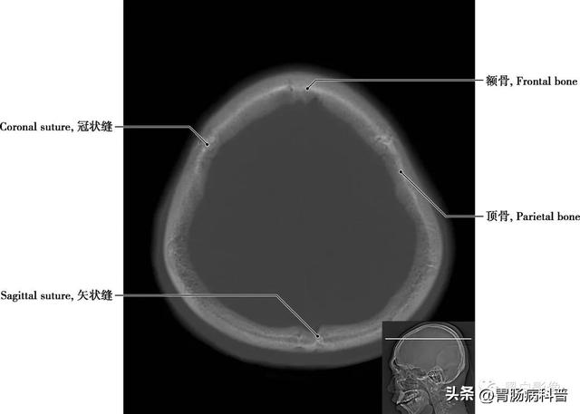 智力扣全套解法图解，智力扣九连环解法（详细标注版——颅脑CT正常解剖图谱）