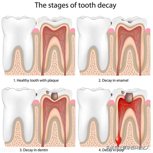大牙凹槽里好多黑色但是不疼，大牙凹槽里好多黑色但是不疼是蛀牙吗（牙齿上有小黑点但是不疼）