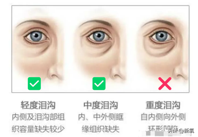 多多红色恋人散粉，多多红色恋人散粉真假大对比【组图】（黑眼圈+乌青泪沟+眼袋）