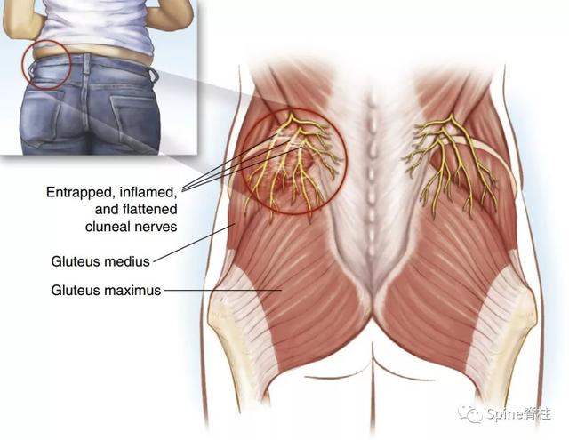 大腿外侧疼痛要警惕四种病，女性膝盖疼痛可能的几种病（易误诊误治的腰痛）