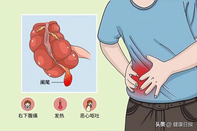 阑尾炎怎么办快速止疼方法，阑尾炎怎么办快速止疼方法吃什么药（阑尾一定要割掉吗）