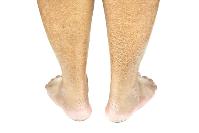 什么是敏感肌肤有哪些表现，别小看皮肤瘙痒