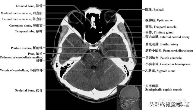 智力扣全套解法图解，智力扣九连环解法（详细标注版——颅脑CT正常解剖图谱）