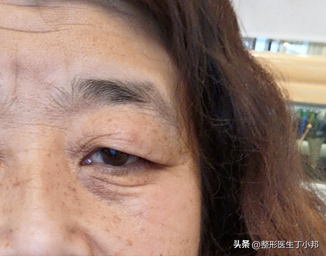 眼睛无神怎么改善，近视眼睛无神怎么改善（眼尾下垂、眼睛无神）