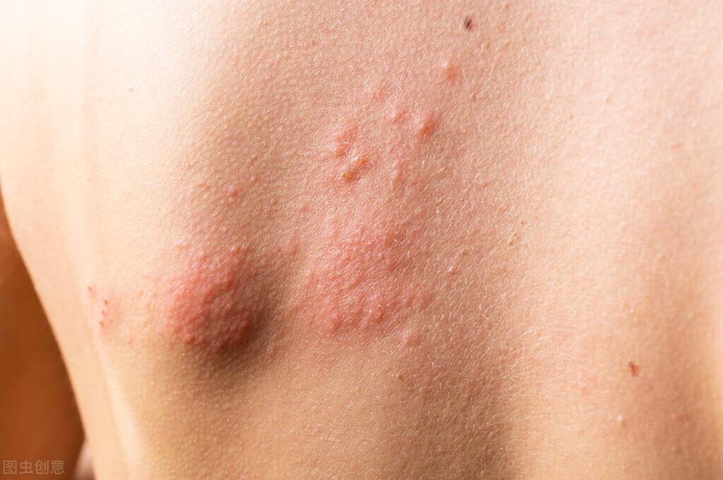 湿疹和癣的区别图片(皮炎和癣病有区别该如何正确区分呢) 