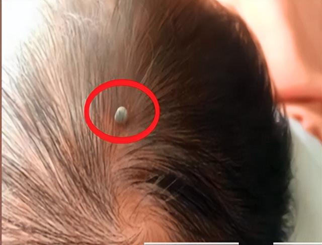 蜱虫是什么，可致命：夏季出游当心此虫（蜱虫是什么样的毒虫）