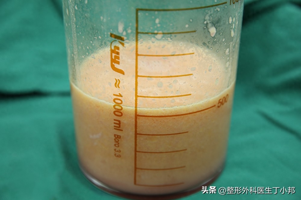 自体脂肪隆胸材料价格多少钱(自体脂肪隆胸真实日记)