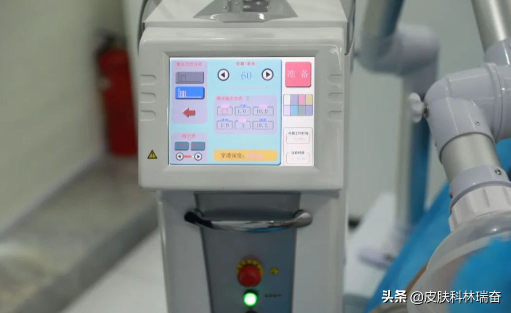 凹陷疤痕激光修复案例（痘坑疤痕的终结者）