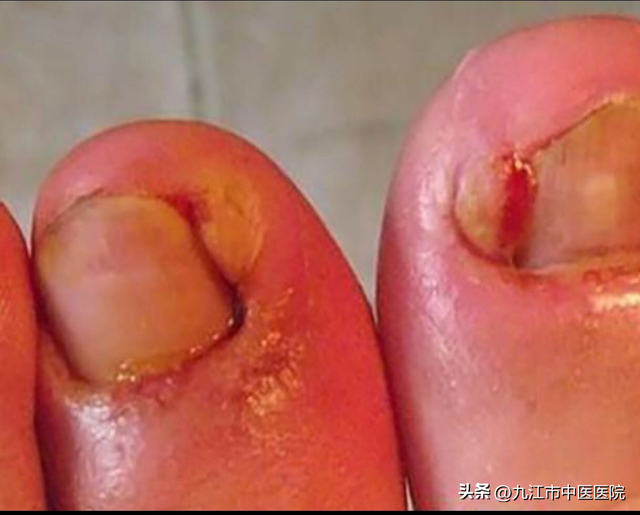 甲沟炎不到10元搞定，甲沟炎长肉芽怎么办?不用拔甲（九江市中医医院帮您搞定）