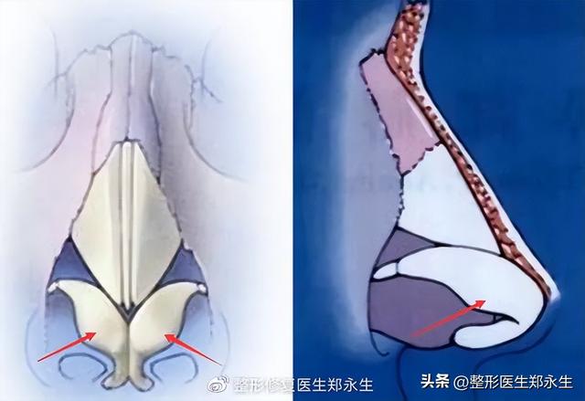 鼻头缩小术千万别做，鼻缩小手术千万别做（肉鼻子做了鼻头缩小结果越“缩”越“大”）