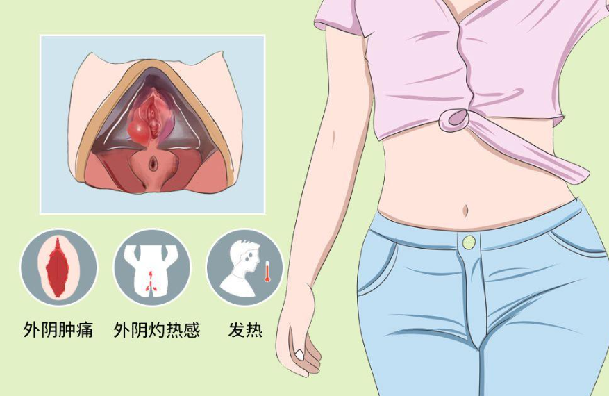 哪些症状提醒前庭大腺囊肿?