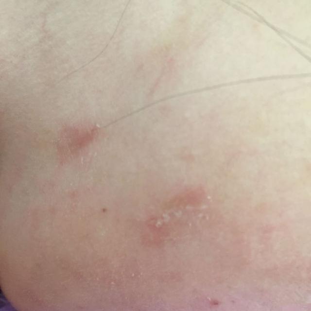 脸部能天天热敷吗，热敷脸有哪些功效与作用（面膜可以天天敷吗）