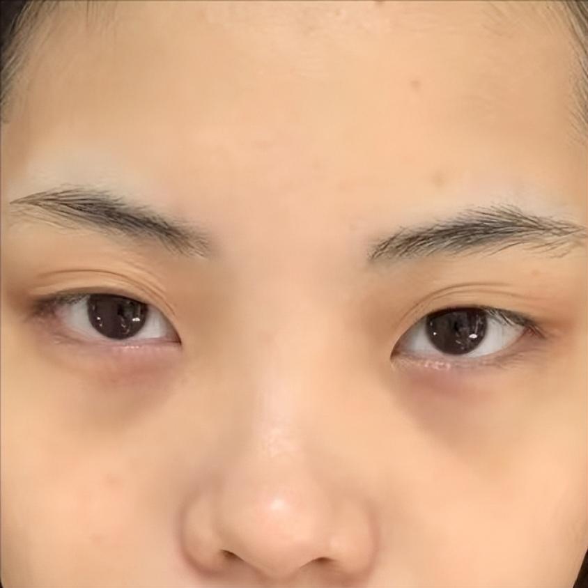 泪沟眼袋是怎么形成的怎样消除,泪沟是眼袋吗 - 玉三网