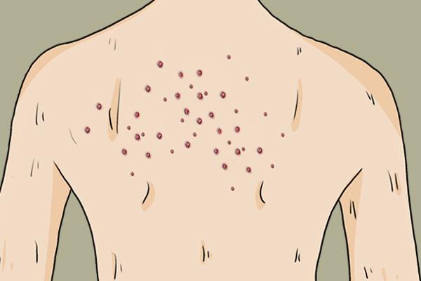 被螨虫咬的症状是什么，被螨虫叮咬的症状（被螨虫缠上的危害）