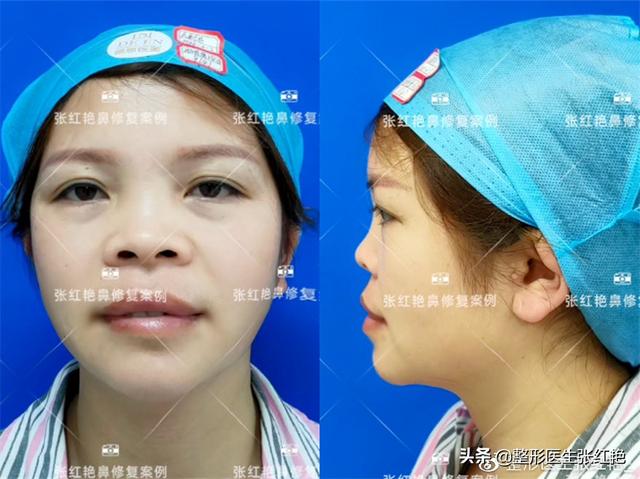 鼻孔大怎么办，鼻子太大怎么自然缩小（成功改造后气质“大变样”）
