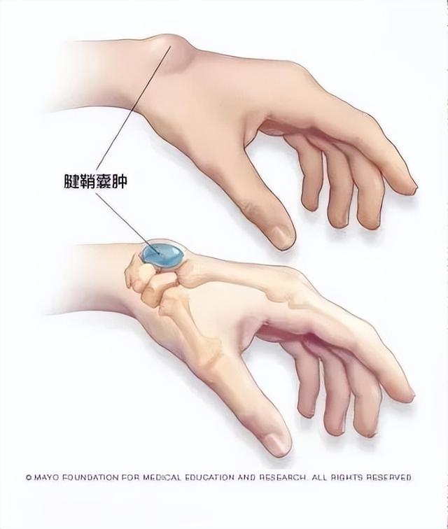 手背腱鞘囊肿图片，手背腱鞘囊肿自愈最佳方法（手背上凸起的肿块被我捏瘪了）