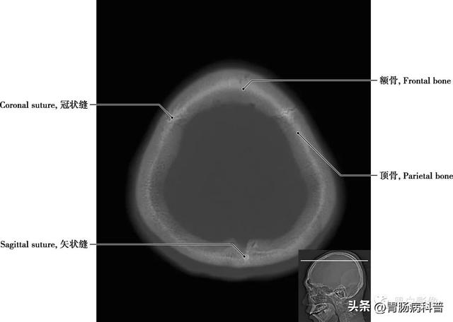 智力扣全套解法图解，智力扣九连环解法（详细标注版——颅脑CT正常解剖图谱）