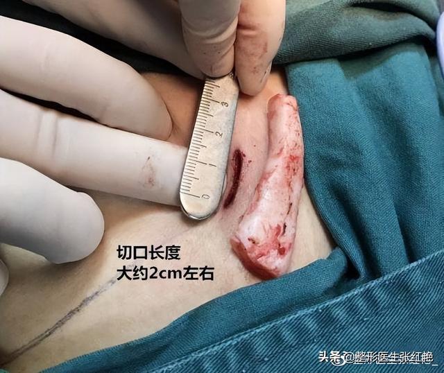 鼻孔大怎么办，鼻子太大怎么自然缩小（成功改造后气质“大变样”）