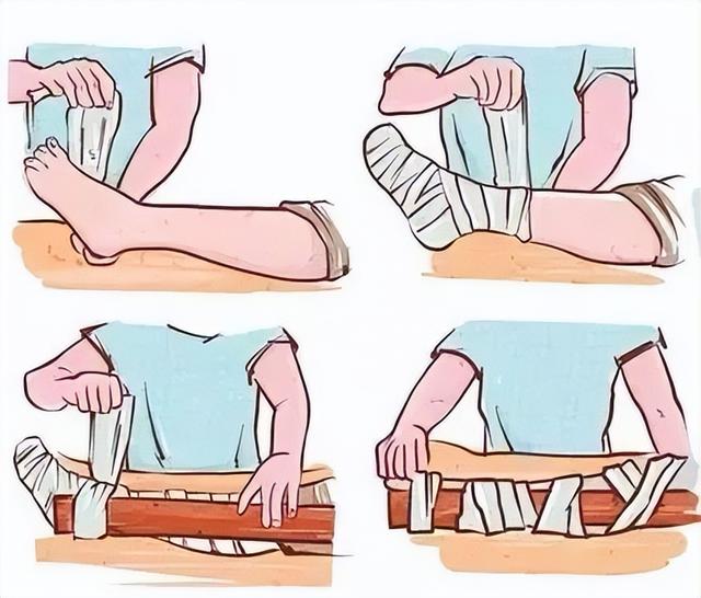 摔伤后怎么处理，如果摔伤了应该怎么办（建议收藏丨学会这些常见损伤的应急处理）