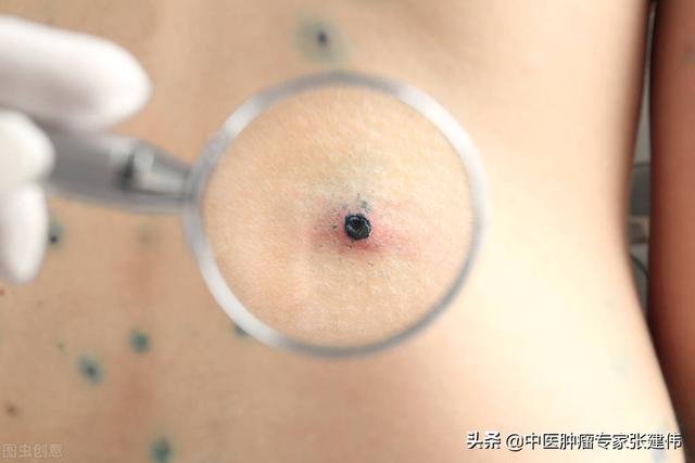 脚上长痣图解大全，全面解析脚上的痣（医生：这几种黑痣容易恶变）