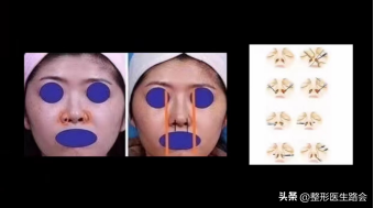 鼻翼肥大怎么办，鼻翼肥大怎么改善（如何改善鼻头圆和鼻翼宽）