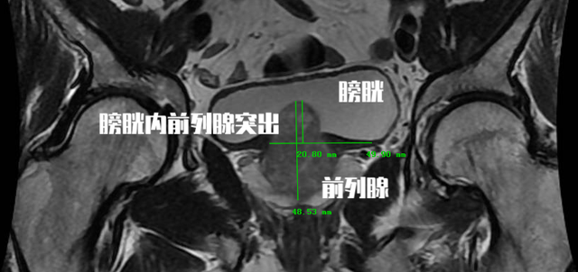 盐酸坦索罗辛缓释片，前列腺炎四大常用药（前列腺增生长期口服坦索罗辛会导致肾功能损伤）