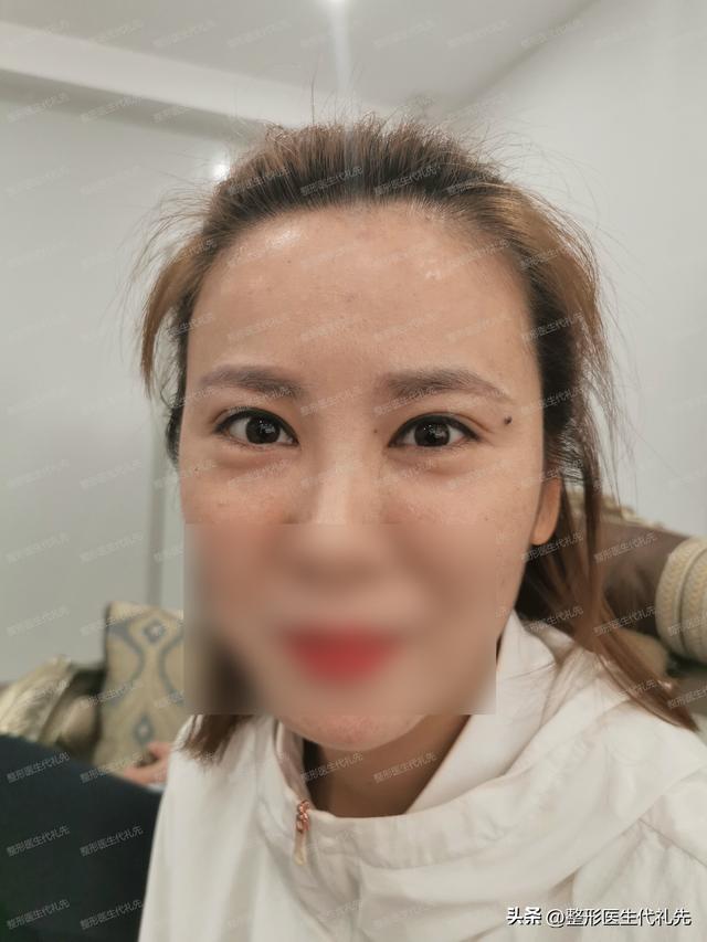 几招小秘方让你眼睛永远年轻，眼睛变大秘方（可以一台手术彻底解决吗）