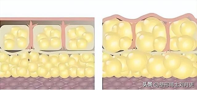 360度环形吸脂多久能恢复，360度环形吸脂多久能恢复好（大腿环吸常见问题解答）