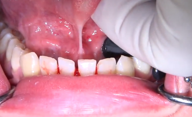 舌系带手术，舌系带手术最佳时间（孩子“大舌头”，必须挨这一刀）