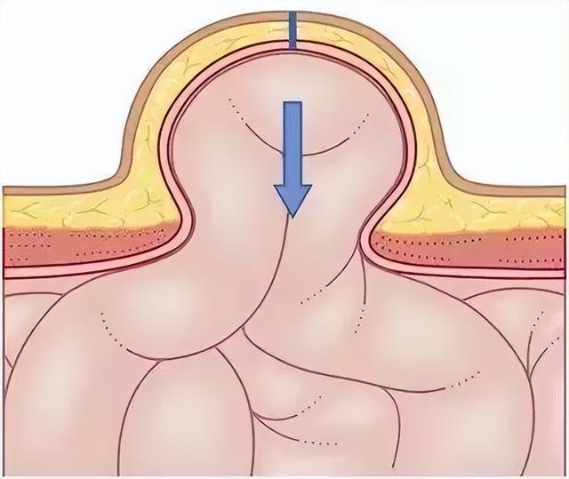 疝气手术微创好还是普通手术好，疝气手术好还是微创好（一日腹腔镜疝手术为您解决担忧）