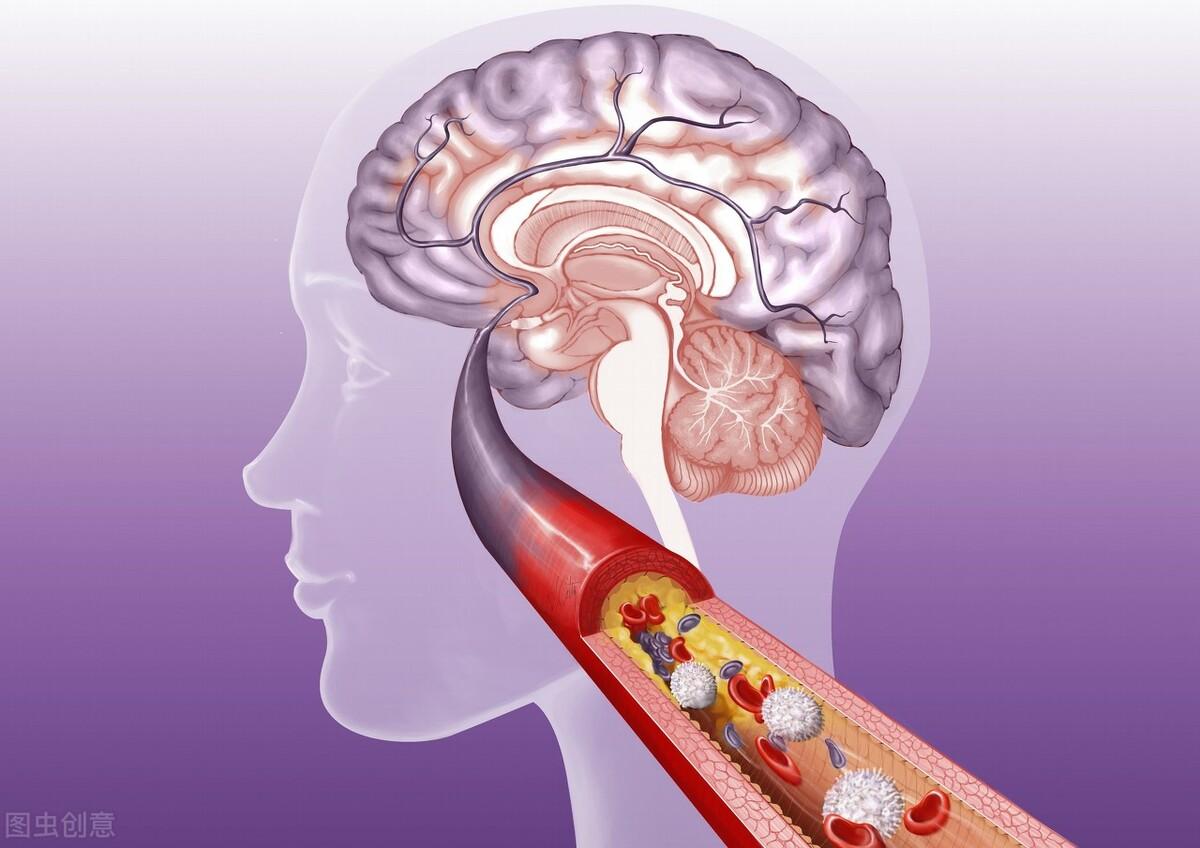 急性脑梗死的关键是什么?