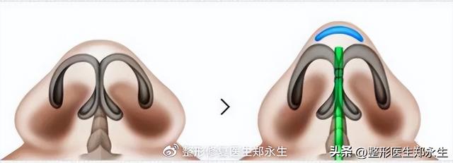 鼻头缩小术千万别做，鼻缩小手术千万别做（肉鼻子做了鼻头缩小结果越“缩”越“大”）