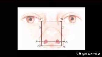 鼻翼肥大怎么办，鼻翼肥大怎么改善（如何改善鼻头圆和鼻翼宽）