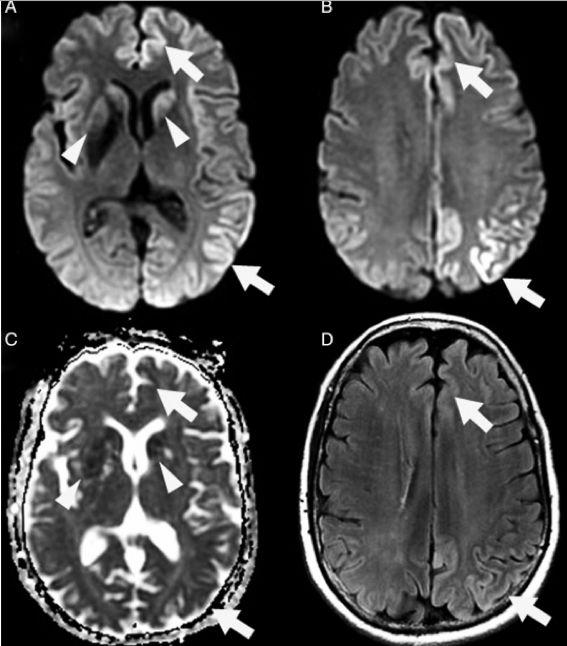 僵尸鹿是真的吗，僵尸鹿是不是真的（扩散非常迅速，会影响人类吗）