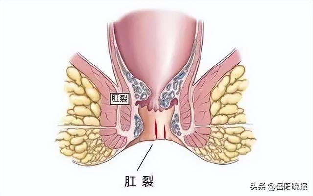 肛裂的位置图片