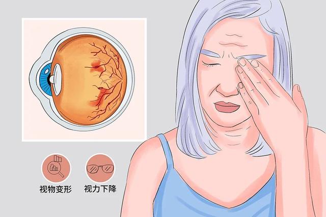 视网膜上的黄斑是什么，视网膜黄斑为什么是黄色（黄斑区多长了一层“膜”严重损害视力）