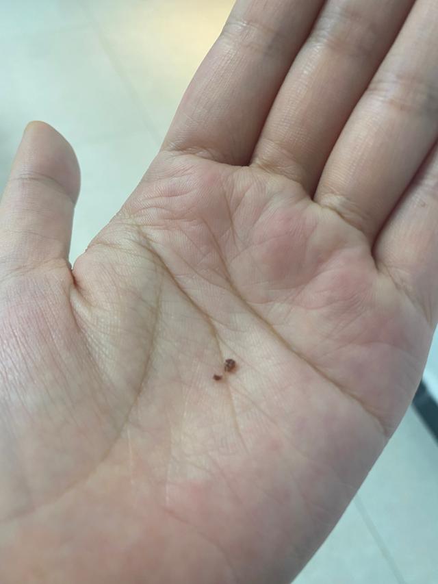 牙结石自己脱落小妙招，牙结石脱落小妙招（再臭的牙石也能自己掉）