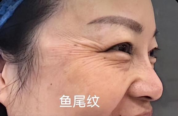眼部下面的纹叫啥纹,鱼尾纹,鸡爪纹不知道该怎么处理 - 玉三网